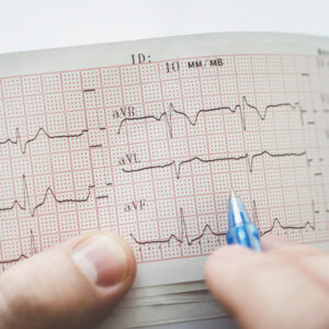 ECG Basic Interpretation